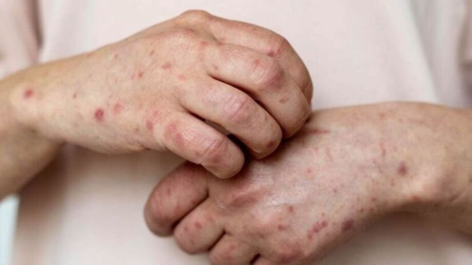 ALERTA EM RIO BRANCO: Caso suspeito de Mpox acende sinal vermelho após registros em estado vizinho